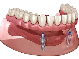 Implant over-denture