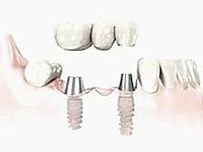 Implant bridge