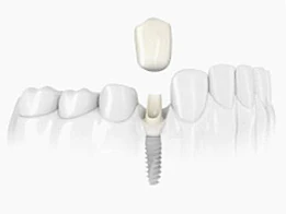 Single implant